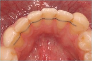 Fig. 10: Intraoral photo taken with mirror by Dr. Gernhardt ZZMK Halle – status before the gingiva defect on 32 was covered