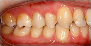 Fig. 2: Intraoral photo right – distocclusion by 1PB, retainer between 13 and 12 visible, 12 enamel aplasia