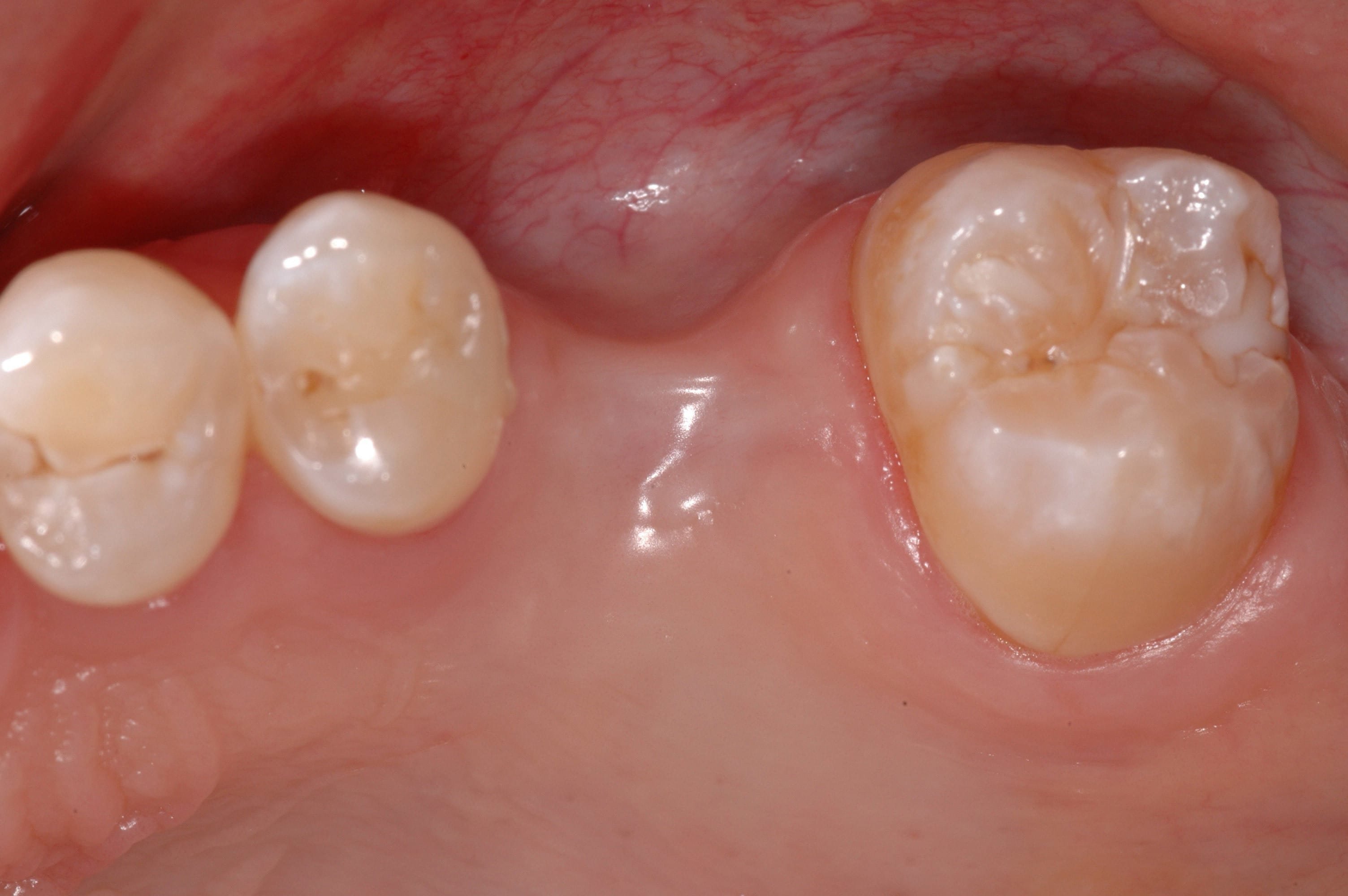 Figure 1: Initial clinical presentation of a 41-year old male patient referred for dental implant treatment planning
