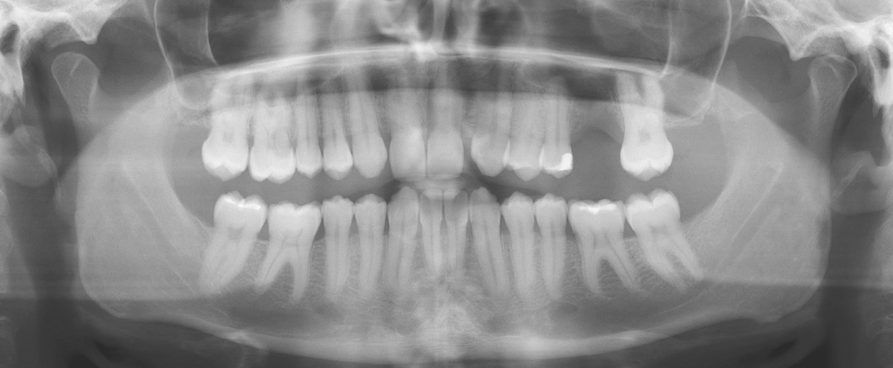 写真2： パノラマ画像は上顎左側臼歯部に1歯欠損があること示す