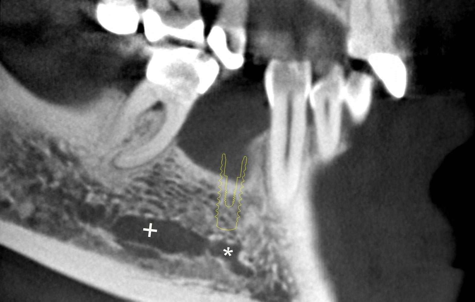 写真1A： 矢状断面像、下顎管（+印）、下顎切歯枝（*印）