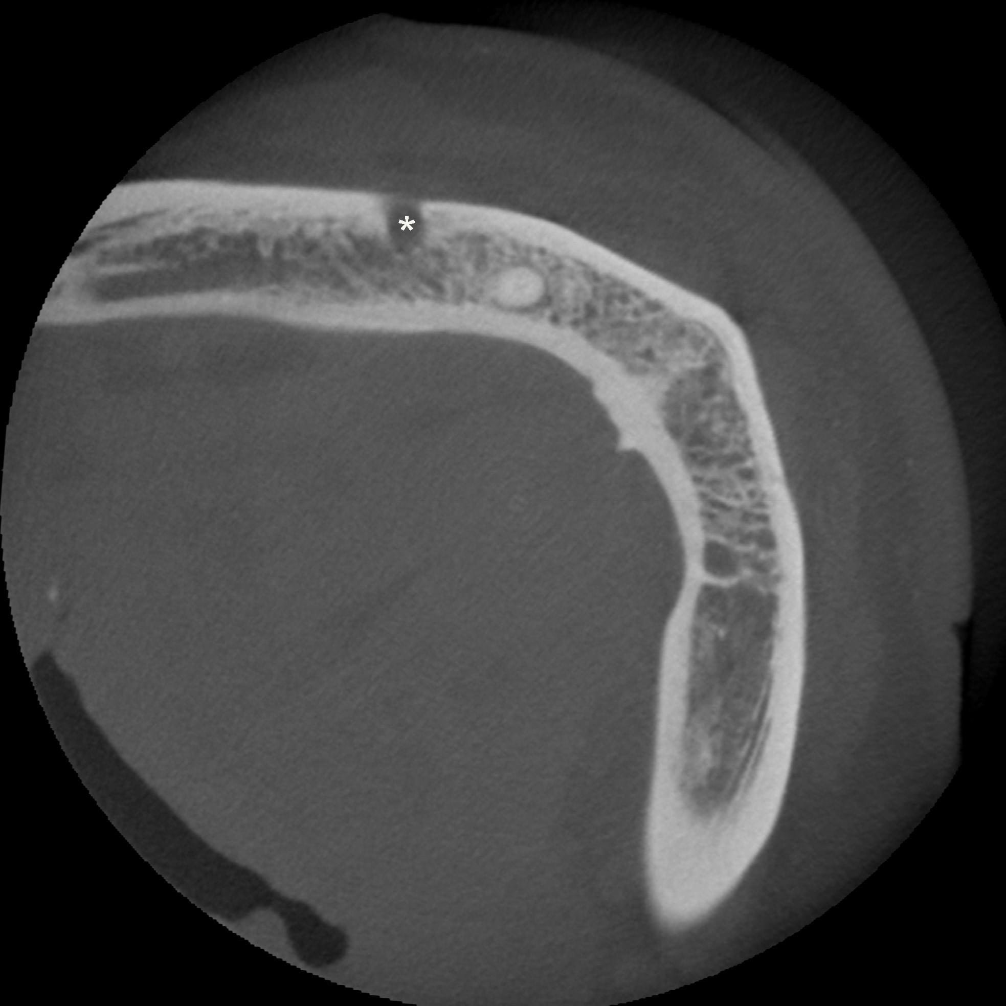 Figure 2F: Axial CBCT image with mental foramen (*)