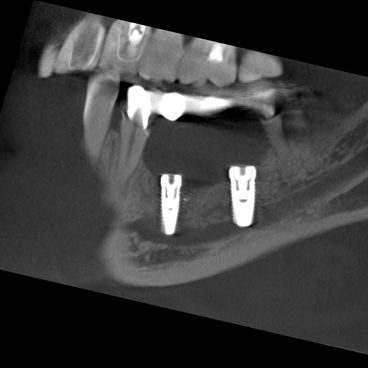 CBCT images damaged nerve channel Veraview X800