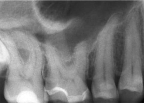 Fig. 1: Dental film regio 16,17