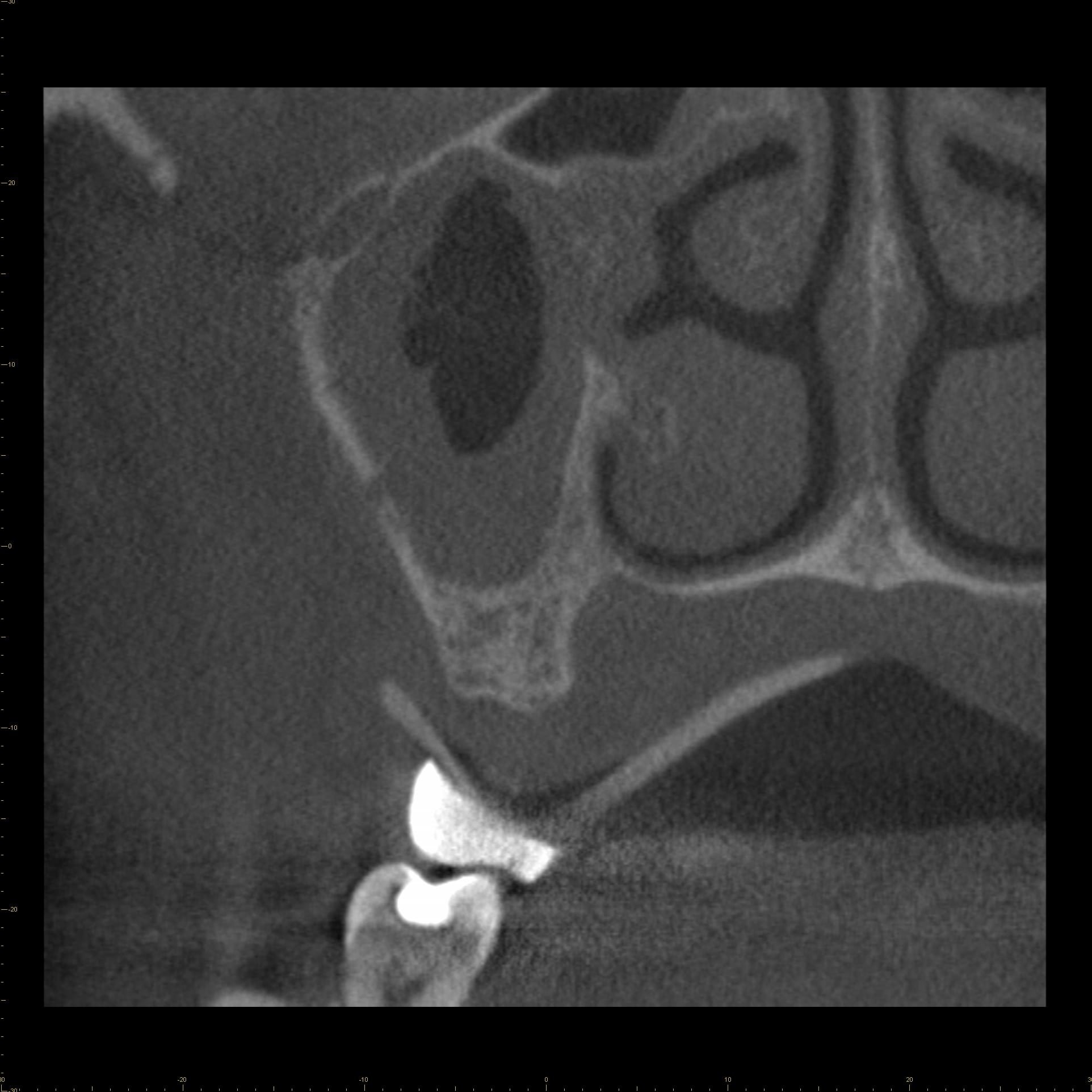 Figure 1D: Coronal CBCT image,second molar region
