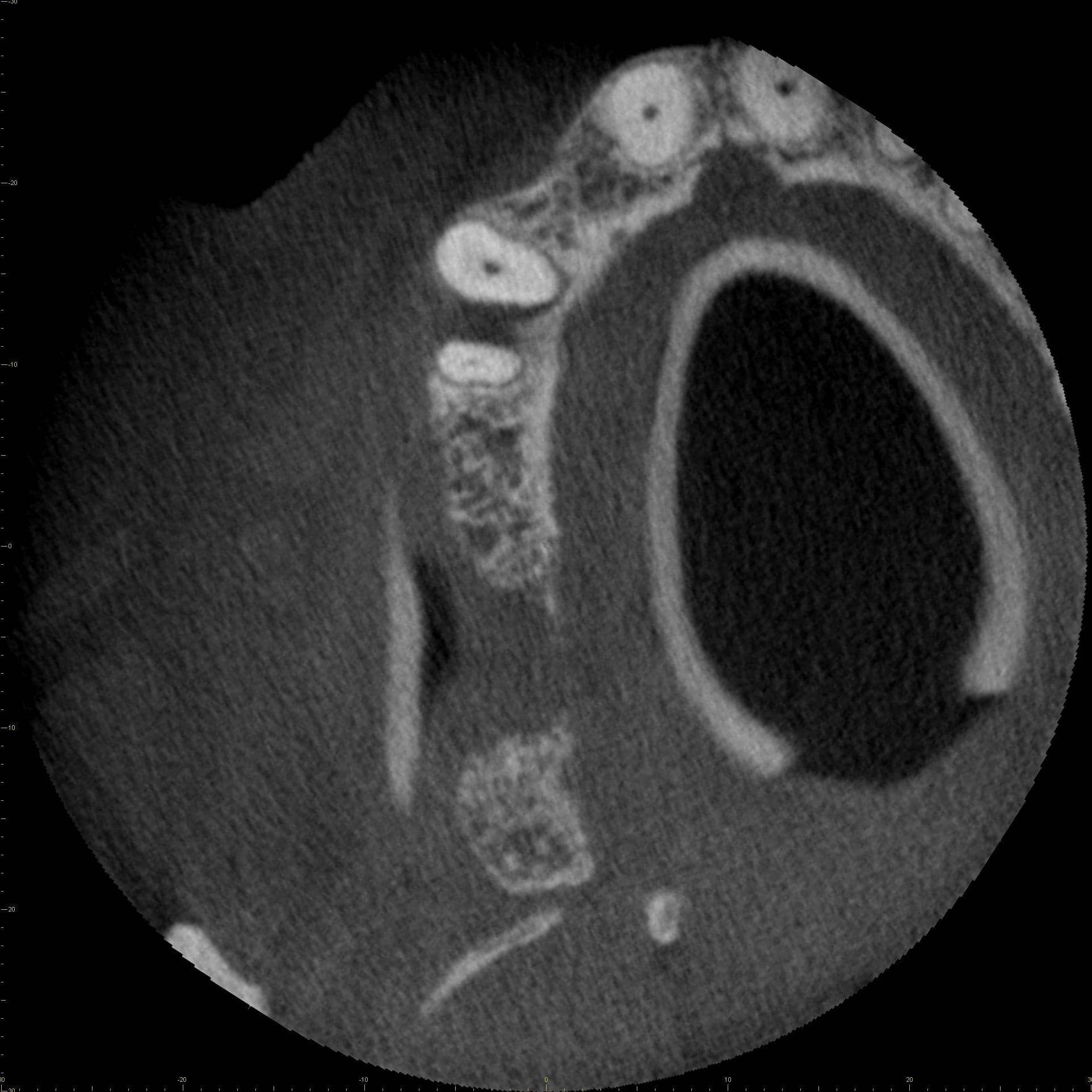 Figure 1E: Axial CBCT image, bone loss between canine and first premolar is visible