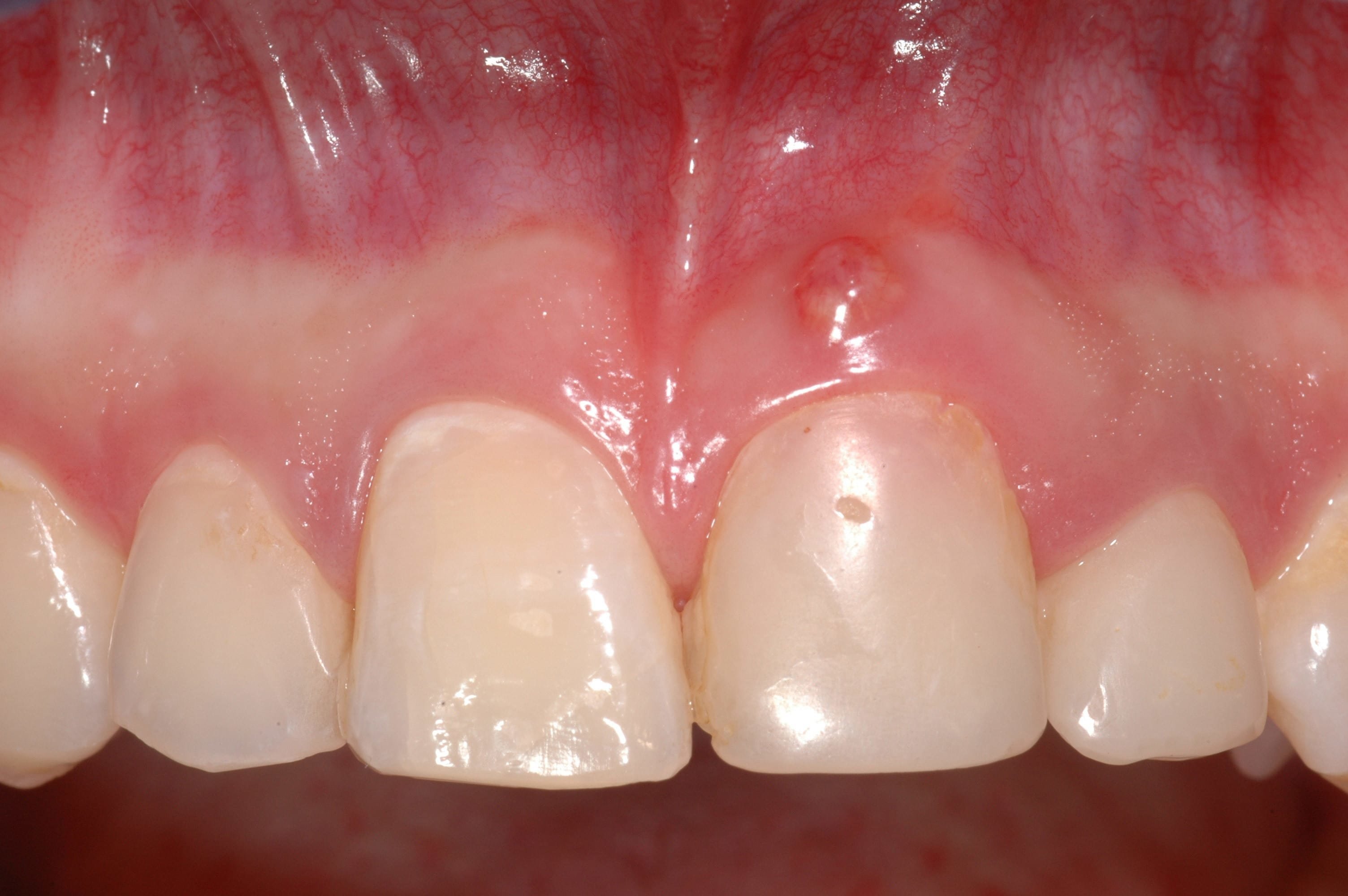 Figure 1: Initial clinical presentation of a 19-year old female patient referred for dental implant treatment planning