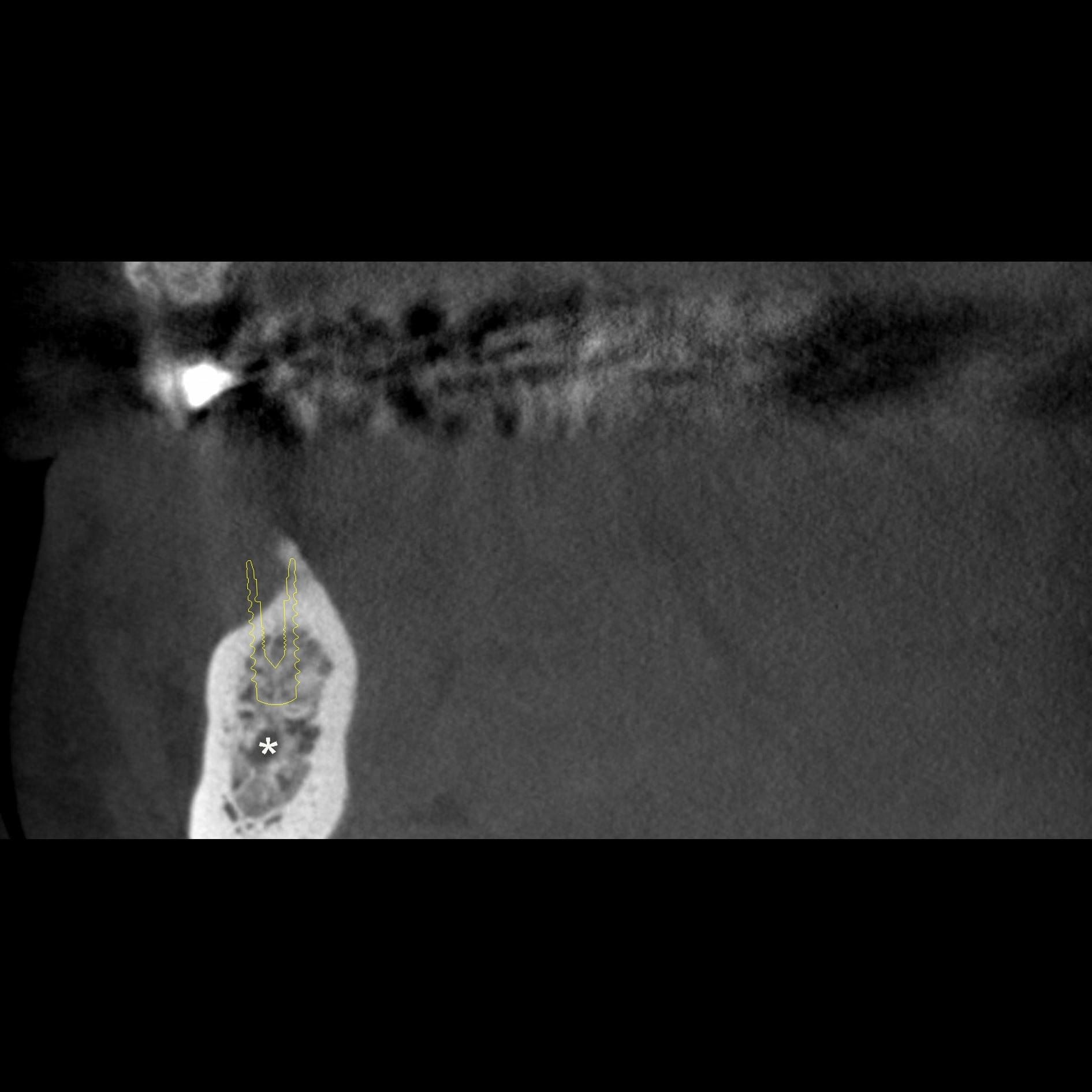 Figure 1B: Coronal CBCT image with incisive canal (*)