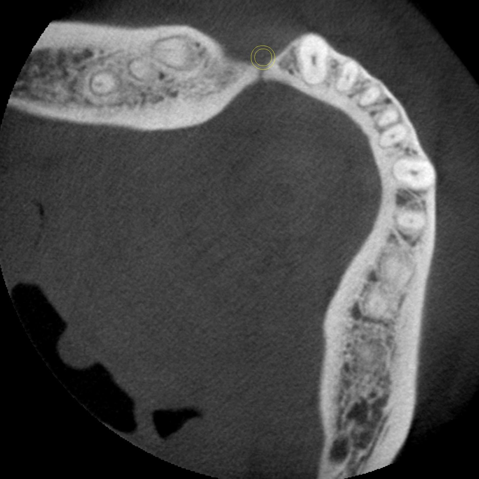 Figure 1C: Axial CBCT image