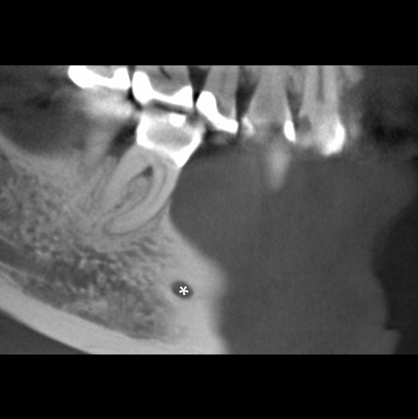 Figure 2A: Sagittal CBCT image with mental foramen (*)