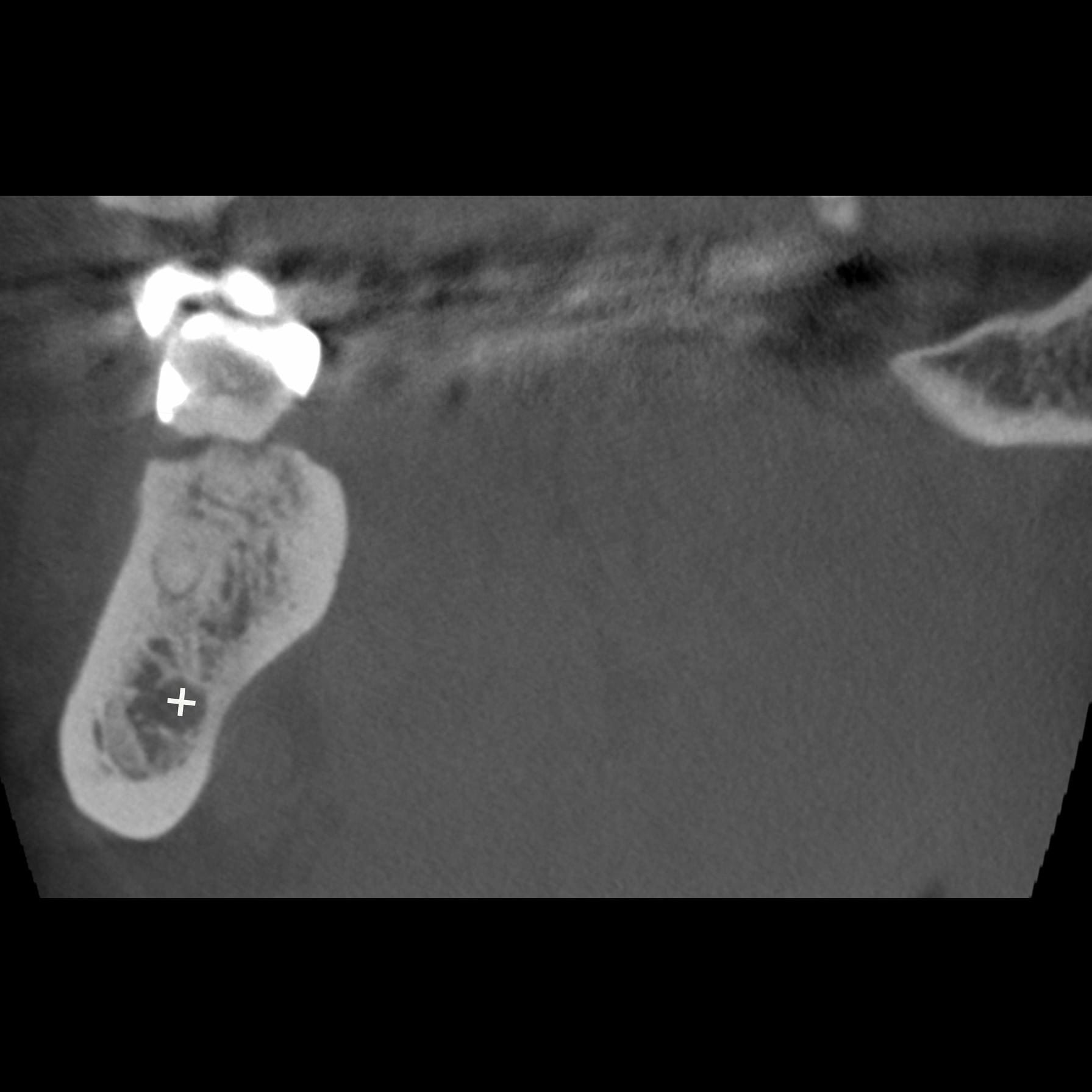 Figure 2B: Coronal CBCT image with mandibular canal (*)