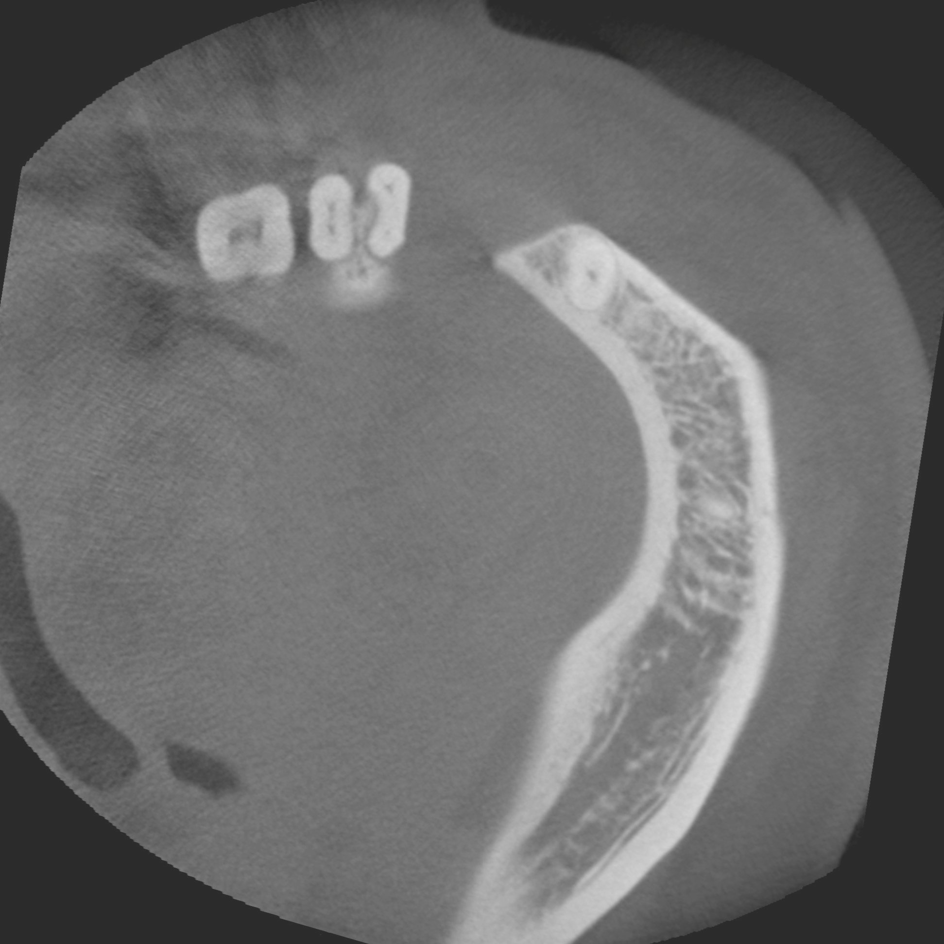 Figure 2C: Axial CBCT image