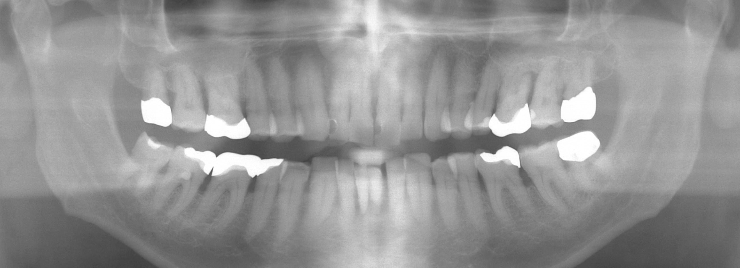 左側上顎第1大臼歯と下顎切歯領域の垂直性欠損を伴う歯周炎による骨吸収を示す