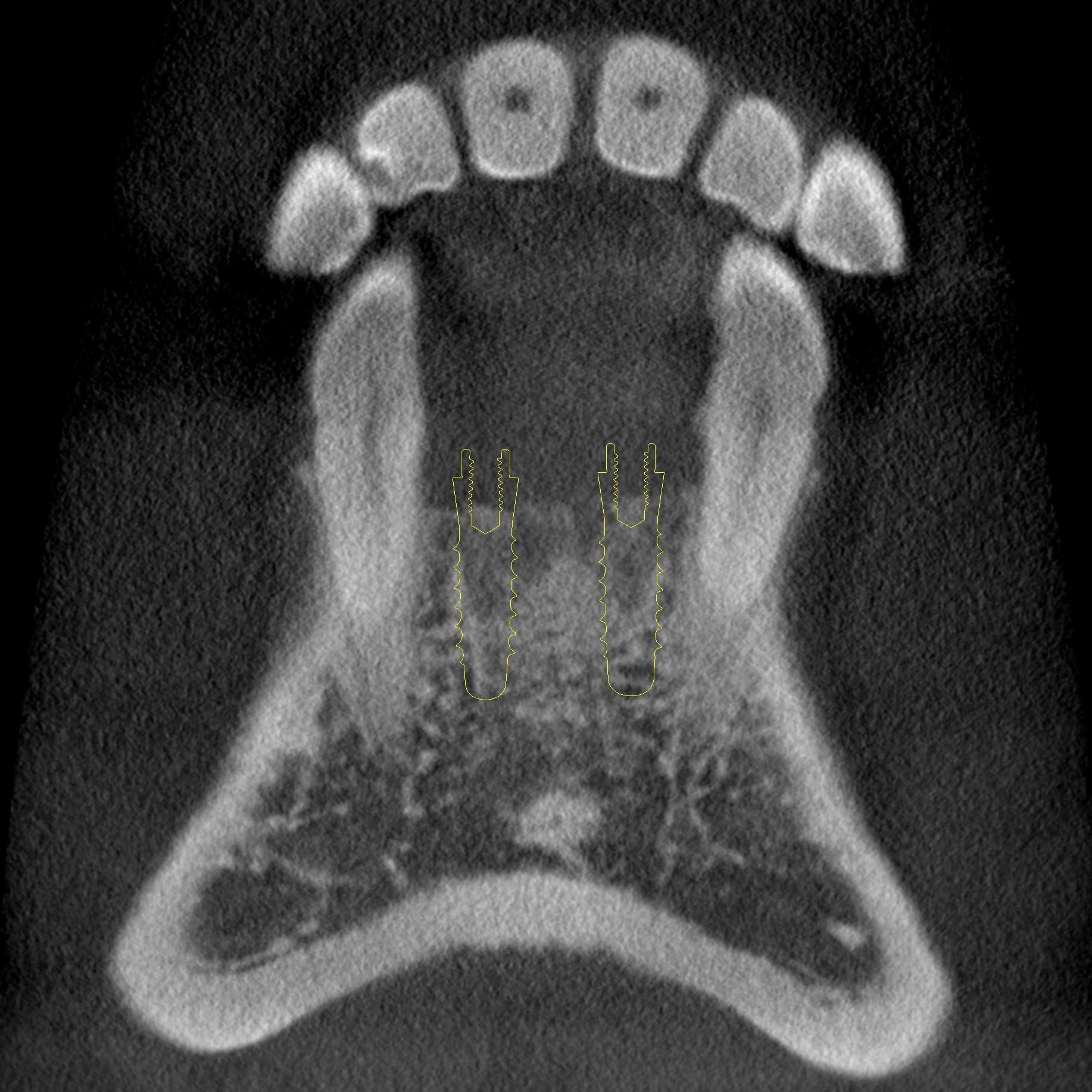 写真2A： 前頭断面像 計画されたインプラントの側方には両側の犬歯がある