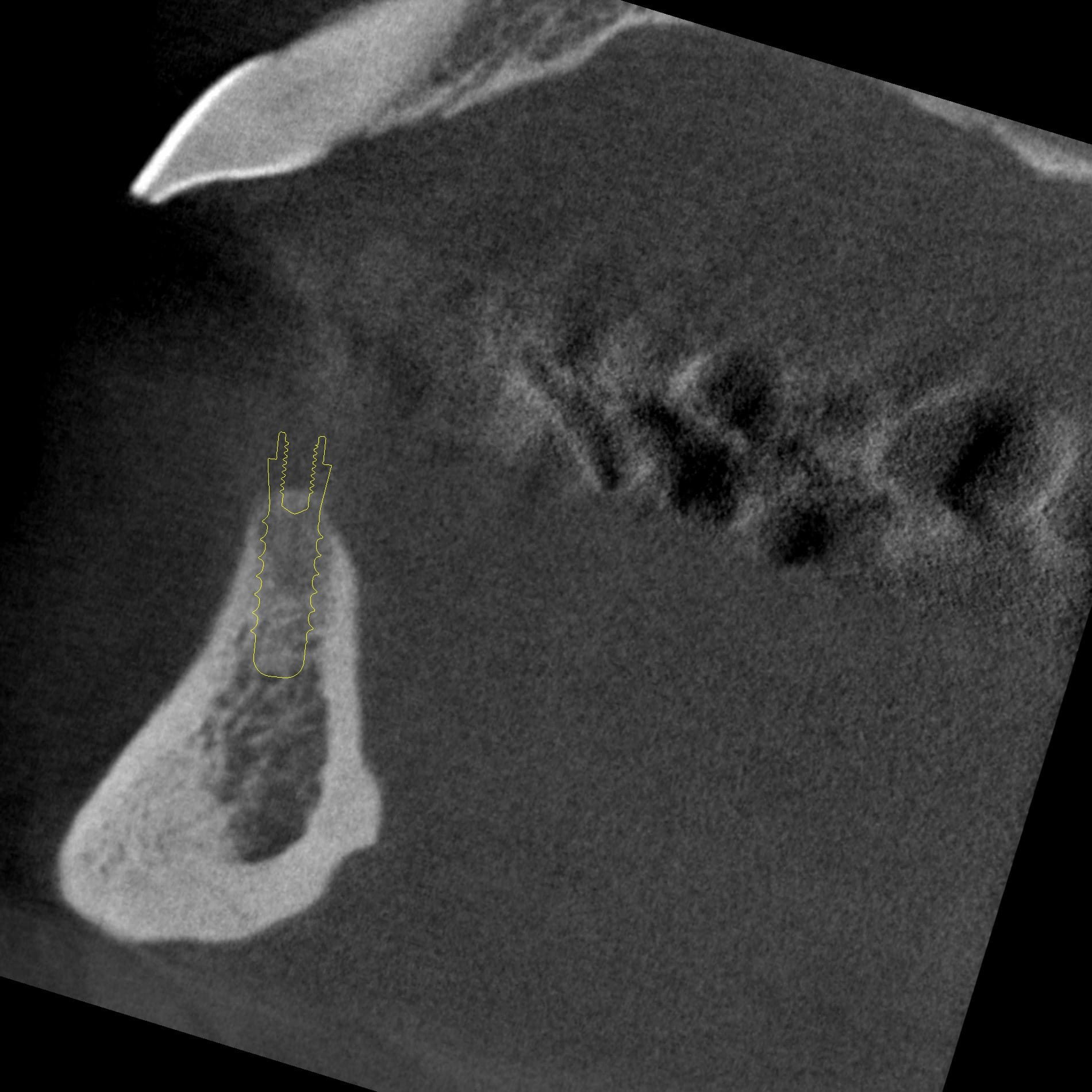 Figure 2B: Sagittal CBCT image for implants in the position of the right and left lateral incisor