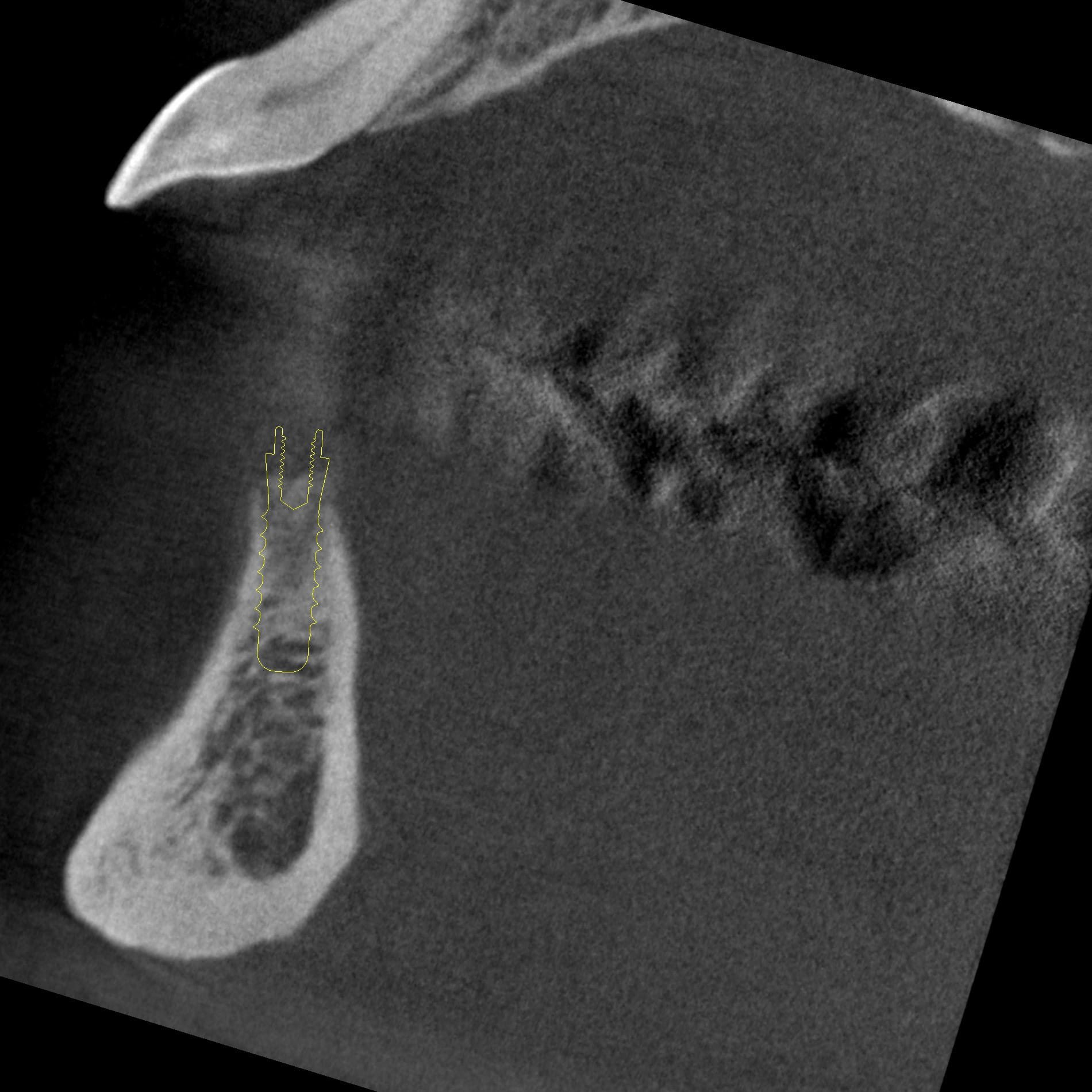 Figure 2C: Sagittal CBCT image for implants in the position of the right lateral incisor