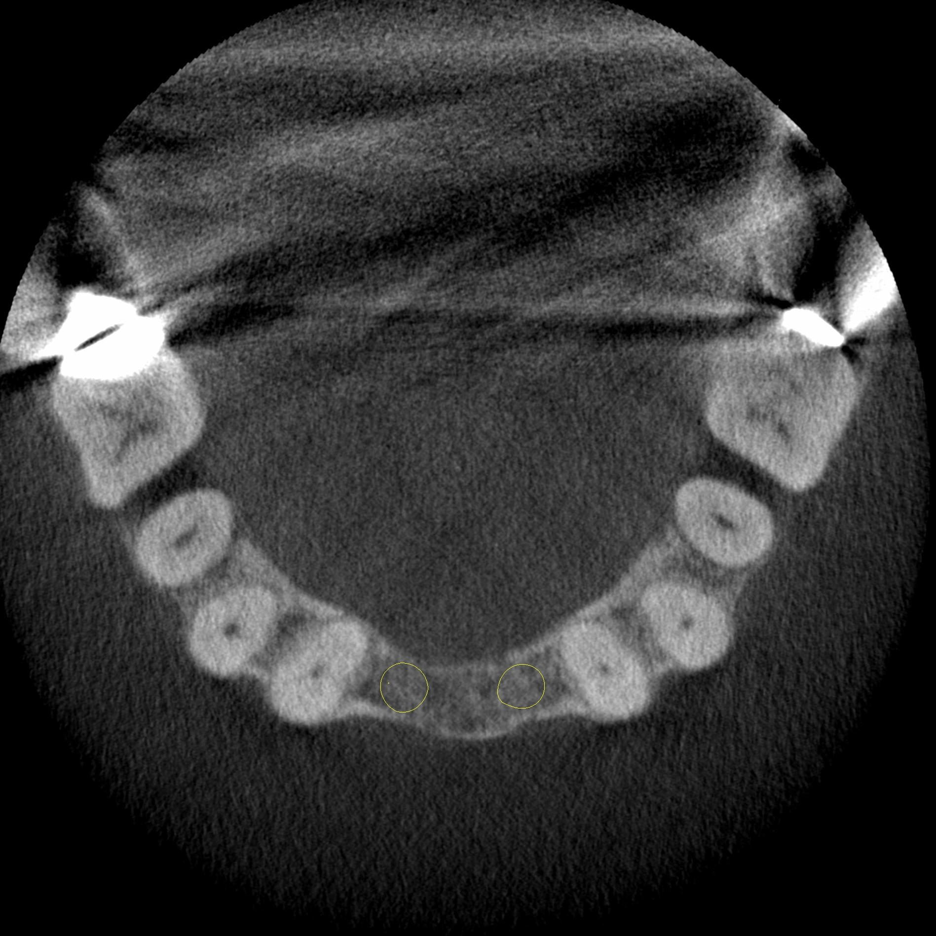 写真2D： 歯槽頂部における軸位断面像
