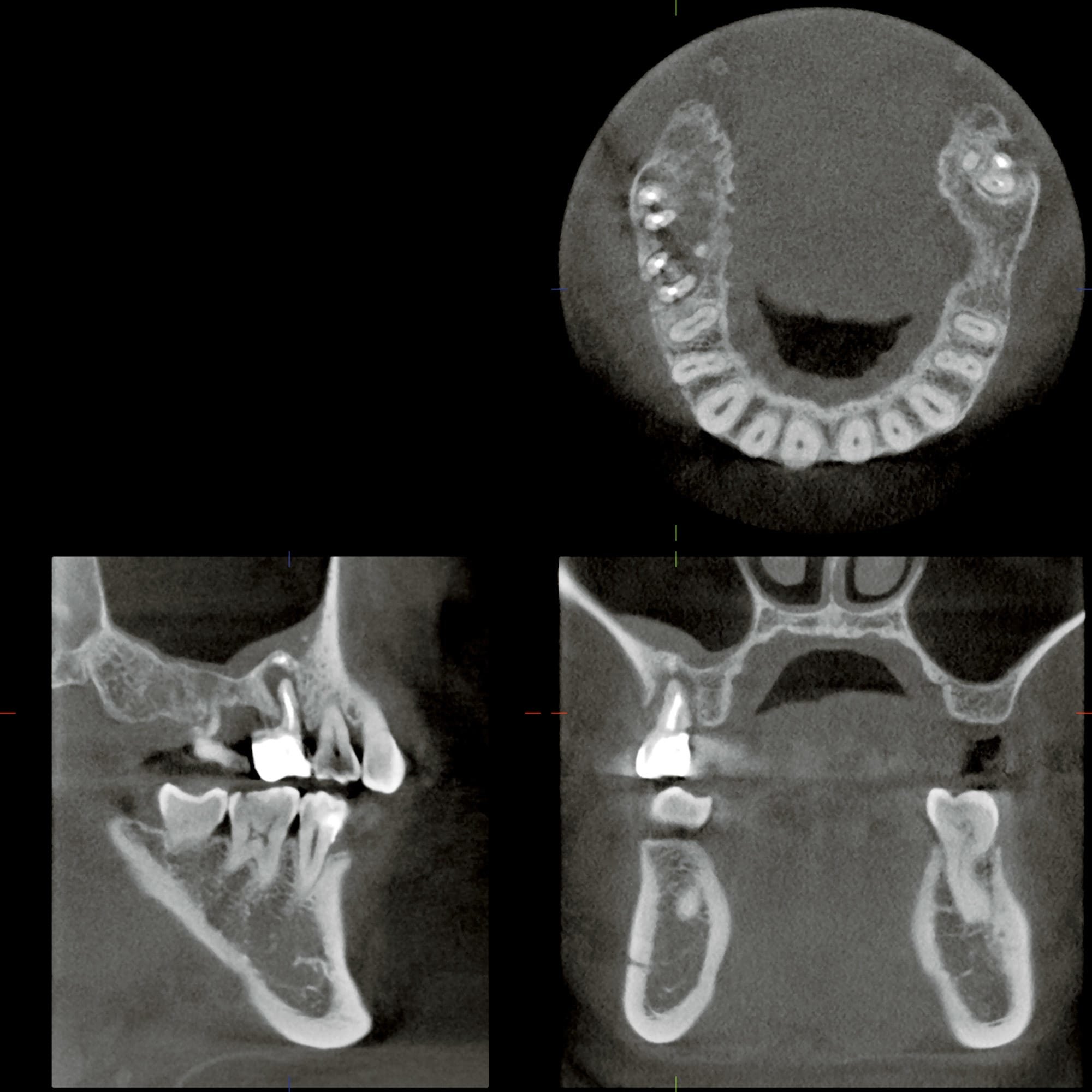 右上6番、7番に根尖周囲に歯槽骨の吸収像が認められる。