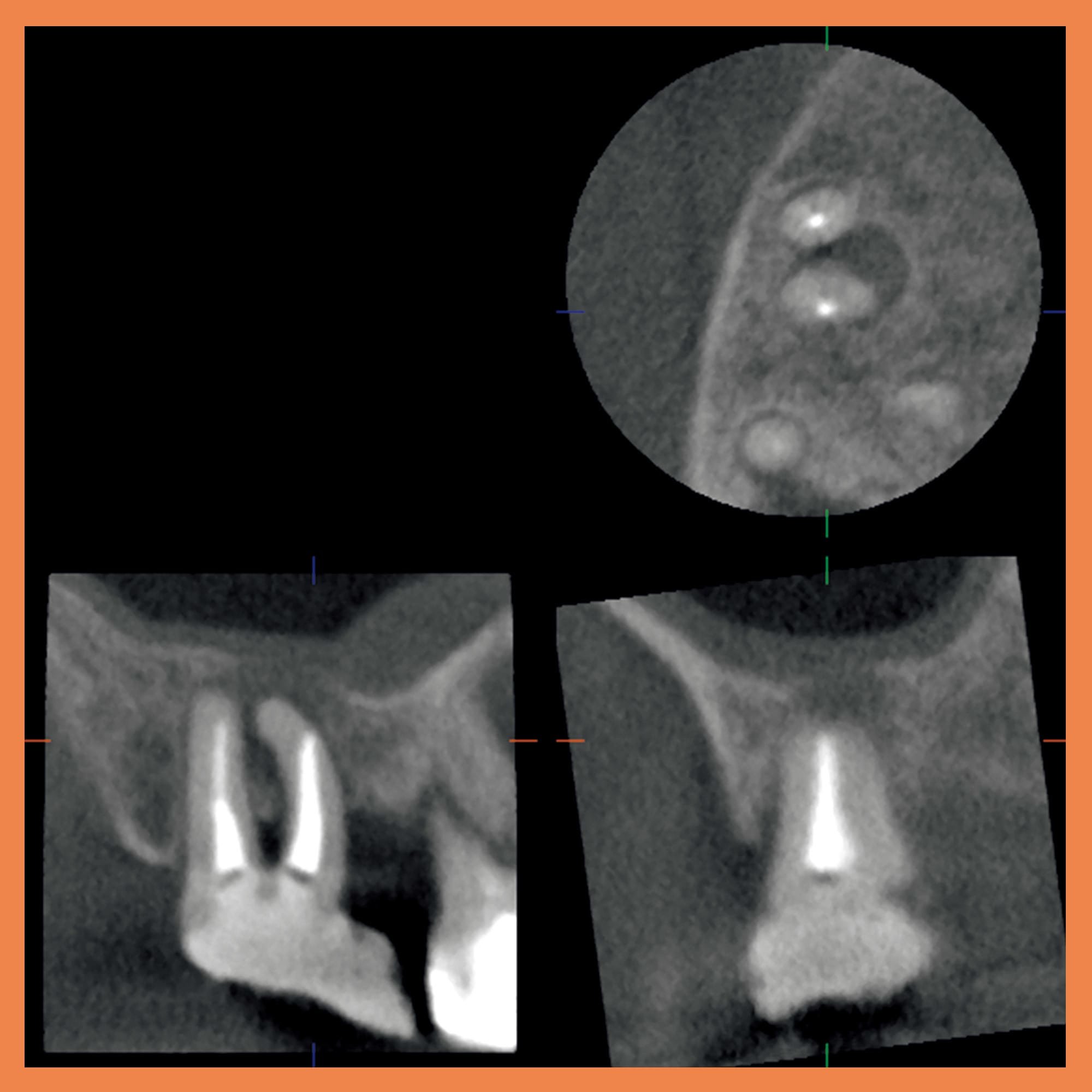 右上7番の近心頬側根の病巣と上顎洞との関係