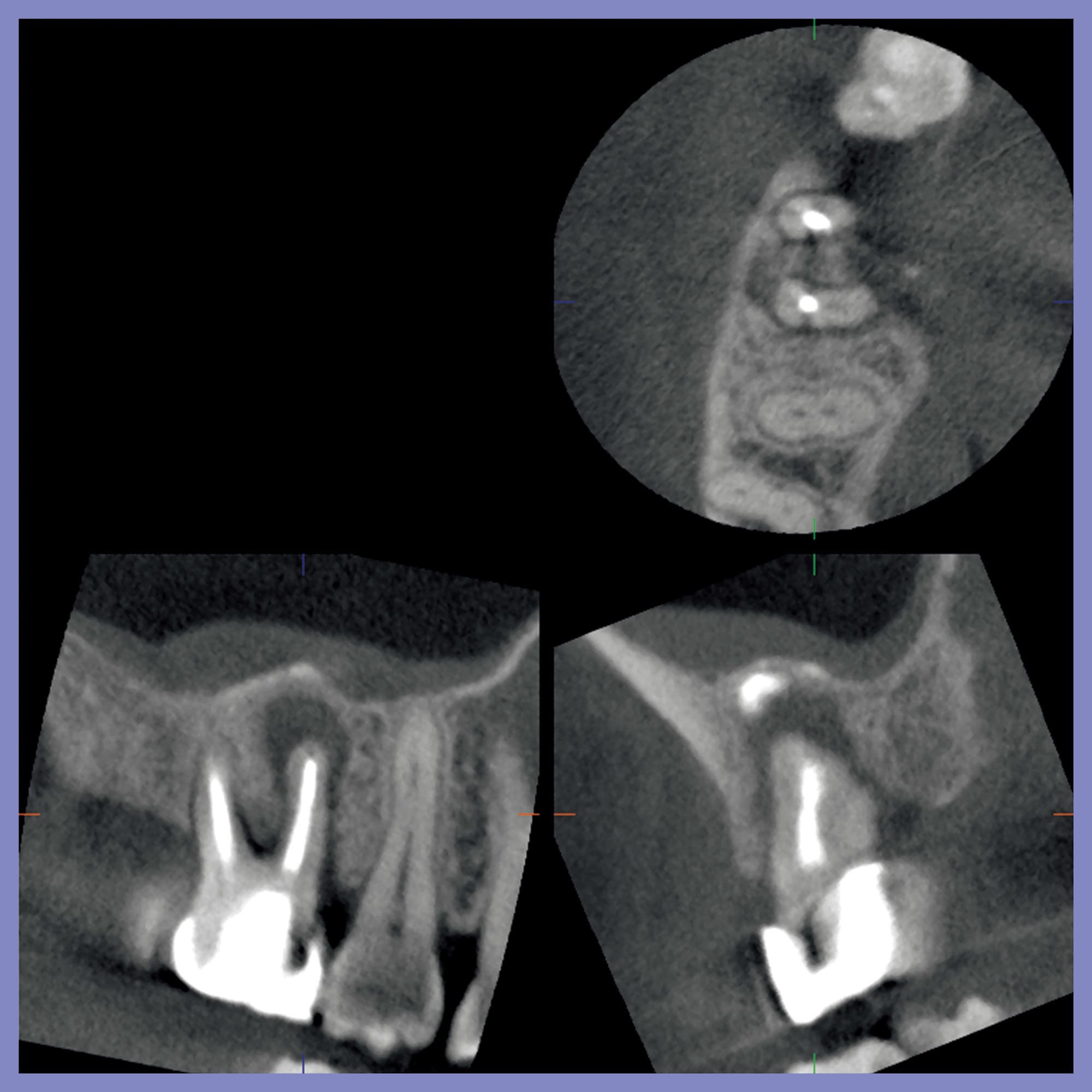右上6番の近心頬側根の病巣と上顎洞との関係