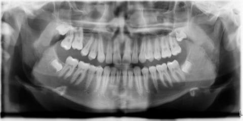 OPG x-ray provided by the orthodontist who had referred the patient shows the initial diagnosis „Infraposition tooth 16.