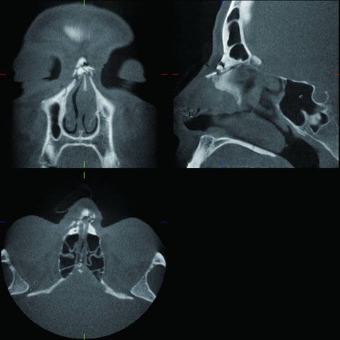 Complicated nasal bone fracture with destruction of soft tissue. Other midface fractures were not diagnosed. Nose piercing on the left side.
