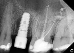 Implant Placed