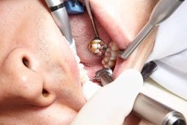 Trepanation on tooth 17